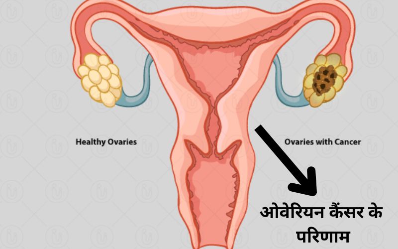 Ovarian Cancer ke lakshan in hindi