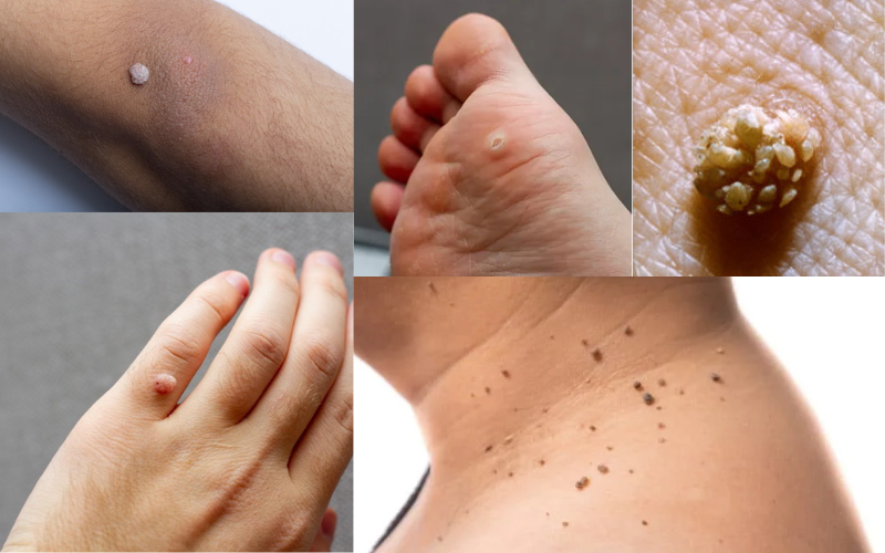 types of warts 